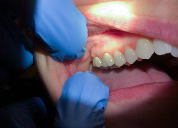 Best Emergency Gum Treatment in Elkhart Lake, WI
