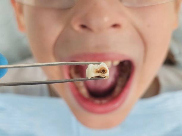 Best Emergency Root Canal Treatment in Elkhart Lake, WI